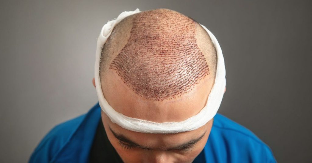 Hair Transplant Cost by Country